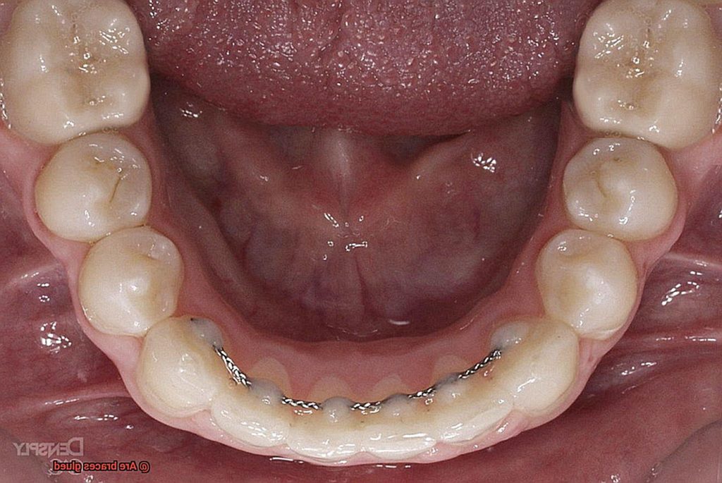 Are braces glued? Glue Things