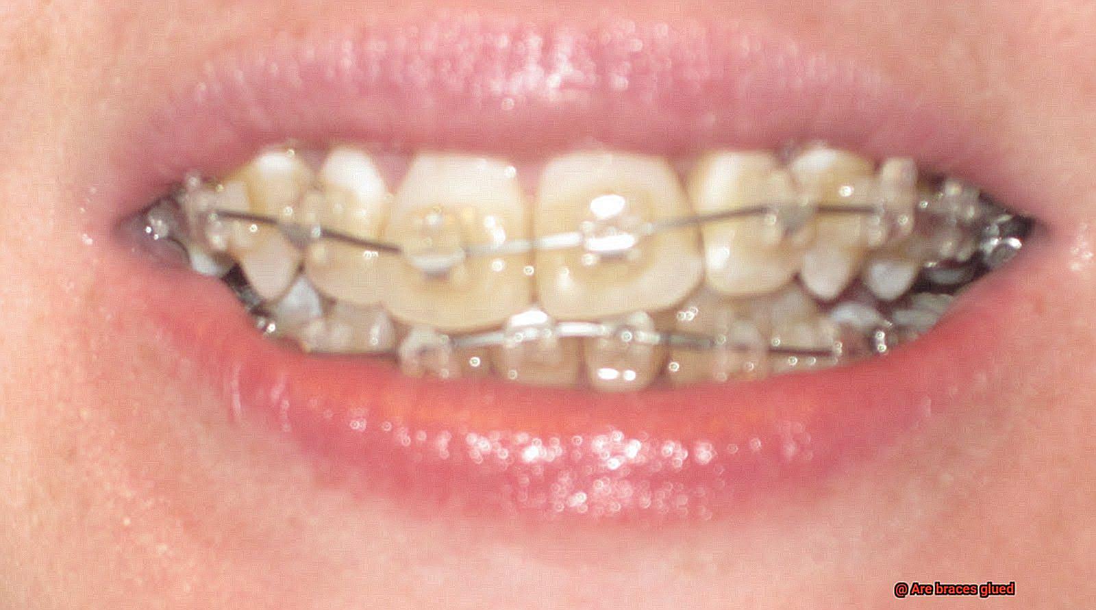 Are braces glued-5