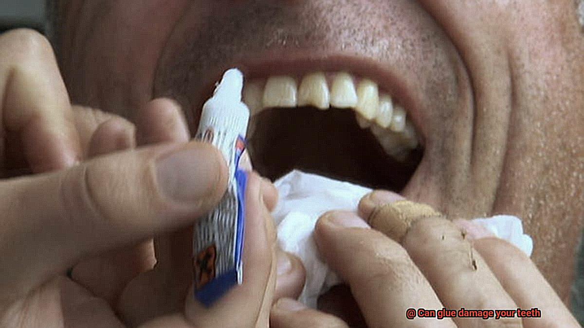 Can glue damage your teeth-3