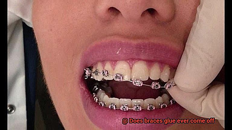 Does braces glue ever come off-5