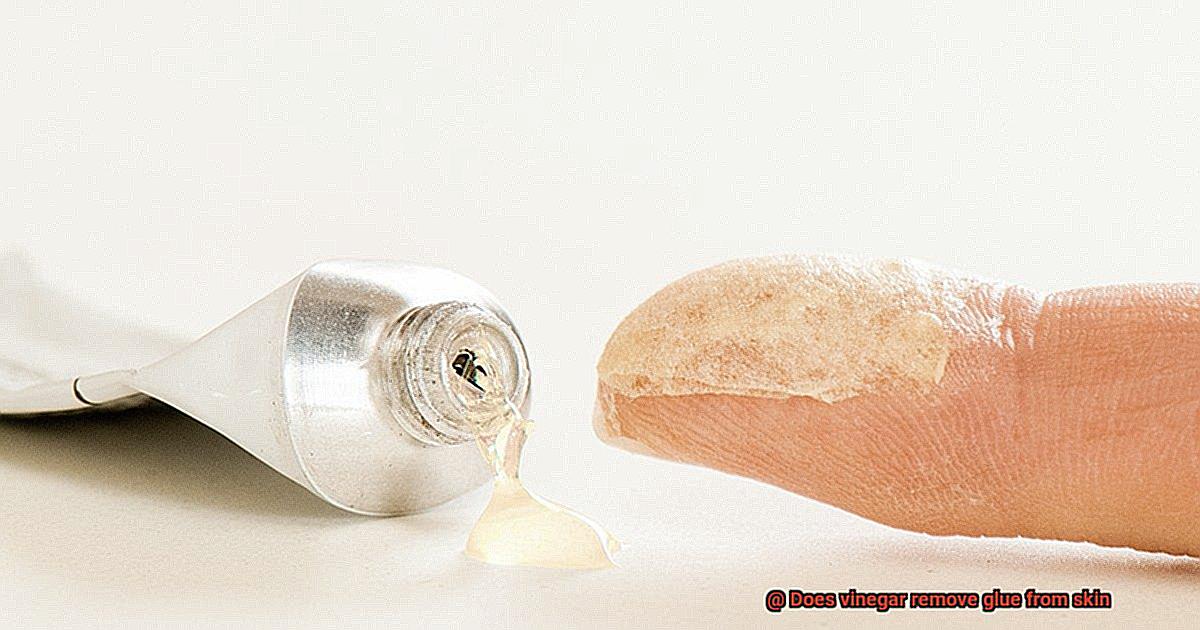 Does vinegar remove glue from skin-4