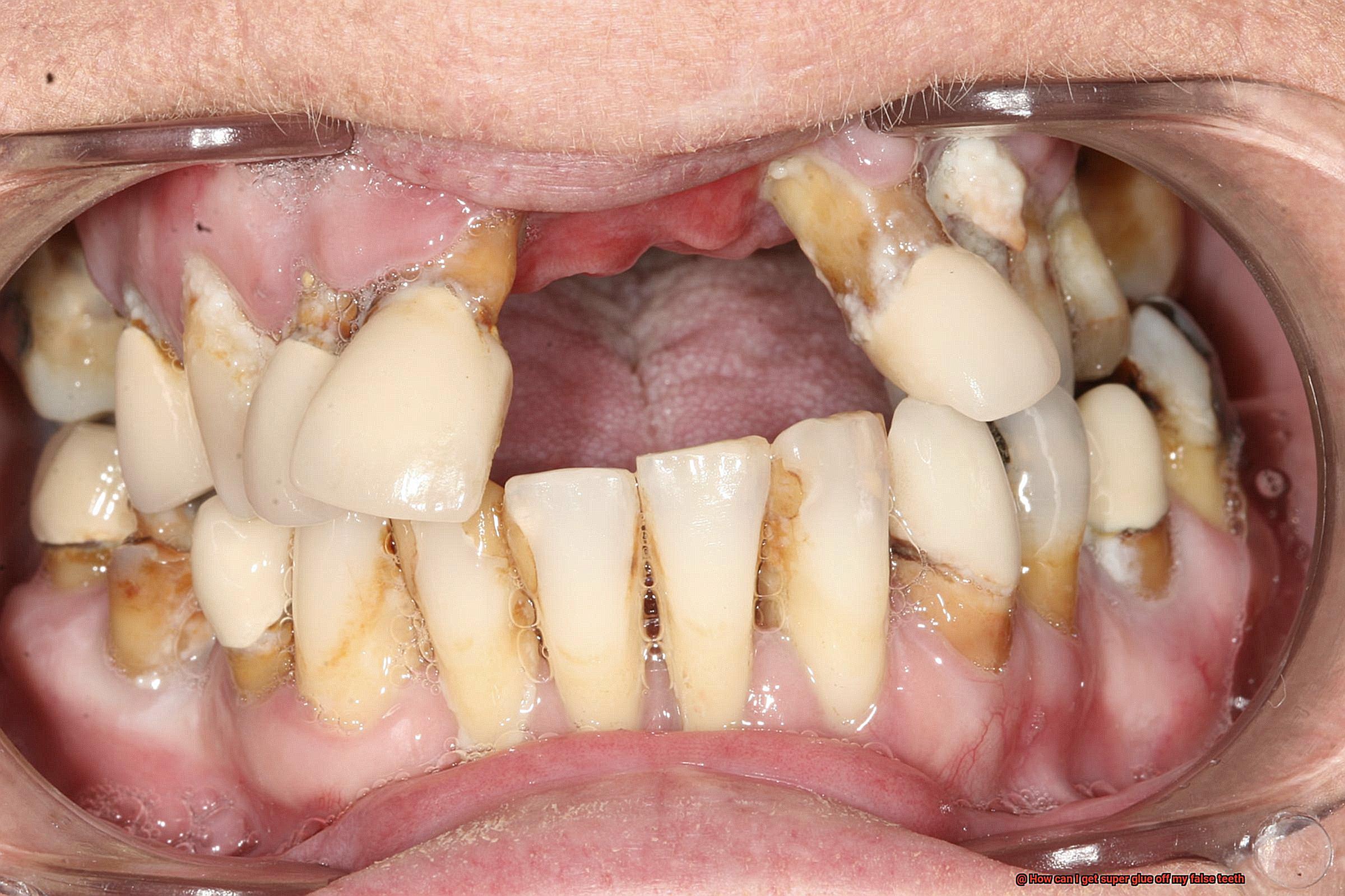 How can I get super glue off my false teeth-2