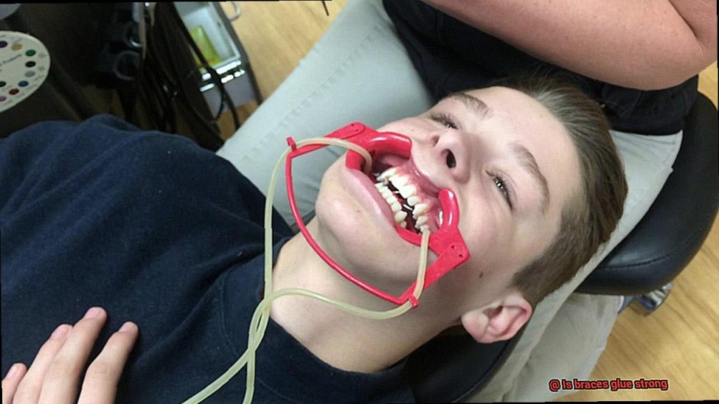 Is braces glue strong? Glue Things